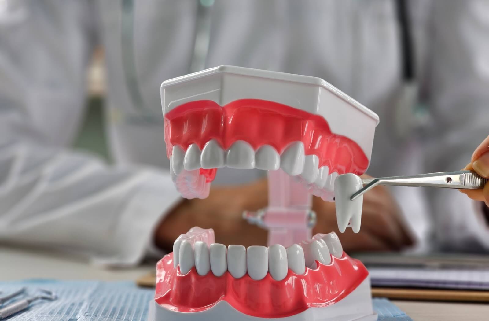 A dental model of human teeth and gums with a dentist using tweezers to point to a molar, illustrating wisdom tooth extraction.